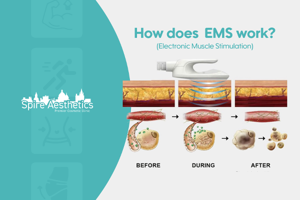 EMS treatment for post pregnancy weight loss treatment Sutton in Ashfield