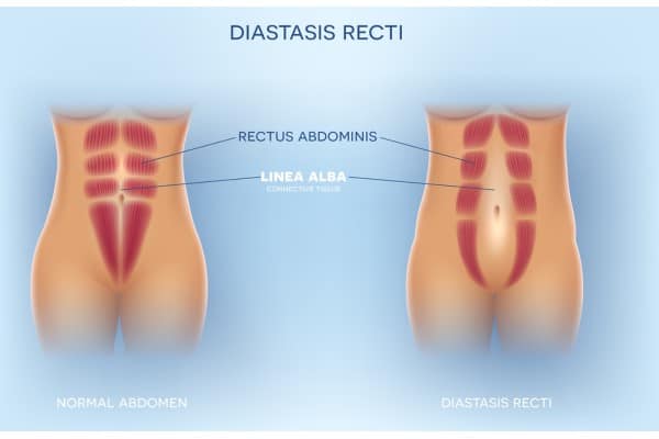 What Non-Surgical Options Are Available for Diastasis Recti Sutton in Ashfield?