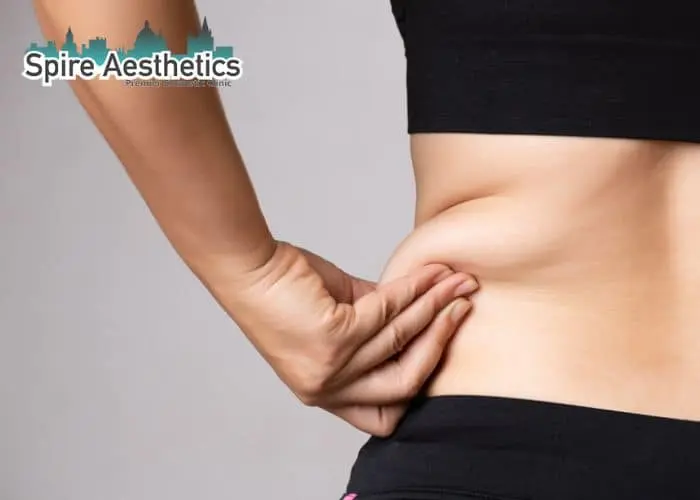 Image of woman pinching fat on their hips Sutton in Ashfield. Fat Freezing treatment