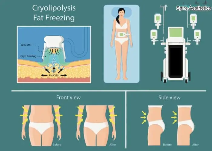Fat freezing treatment Sutton in Ashfield benefits for competitions to remove stubborn fat deposits.