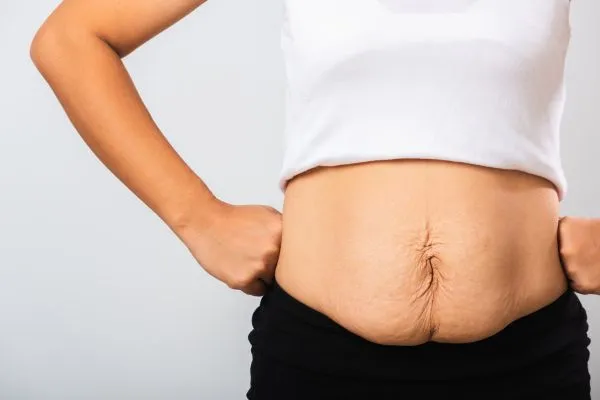 Image of a woman's stomach after weight loss with sagging skin following a gastric band Sutton in Ashfield