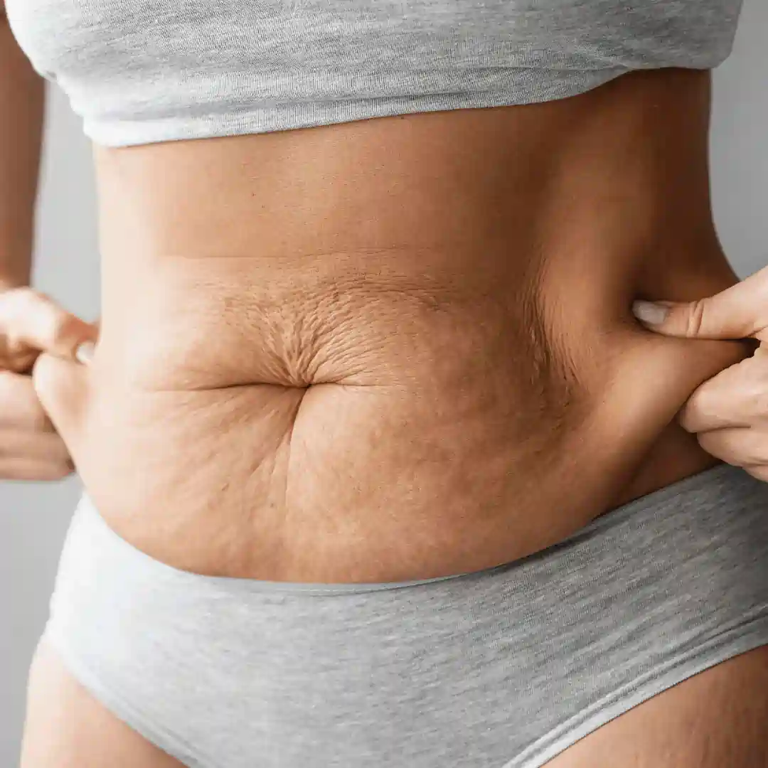 Is It Normal to Have Loose Skin After Pregnancy Sutton in Ashfield?