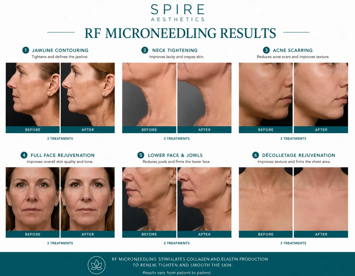 RF Microneedling Skin tightening Sutton in Ashfield results