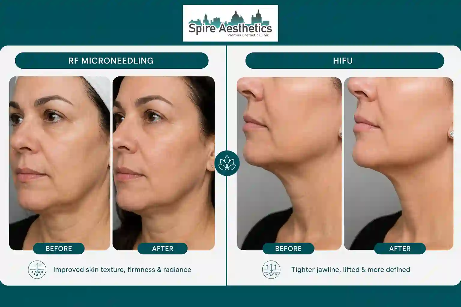 Can RF Microneedling and HIFU Be Combined Sutton in Ashfield?