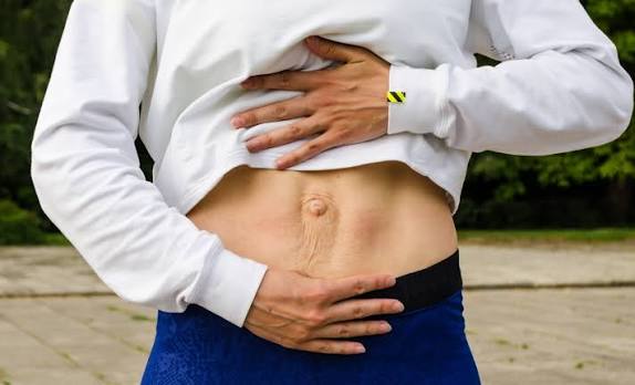 When Could Diastasis Recti Be the Missing Piece of the Puzzle Sutton in Ashfield?